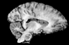 Middle cerebral artery distribution infarct, sagittal section.